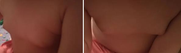 一侧乳房发育疼痛是真早熟吗,女宝宝假性乳腺发育是早熟吗