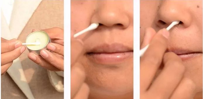 过敏鼻炎最怕的克星,过敏鼻炎快速通鼻塞