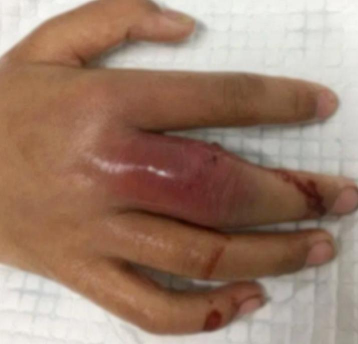 与它“握”了个手，男子手指红肿溃烂！医生：别大意