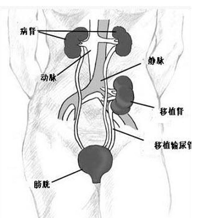 肾移植科普,张龙肾移植科普