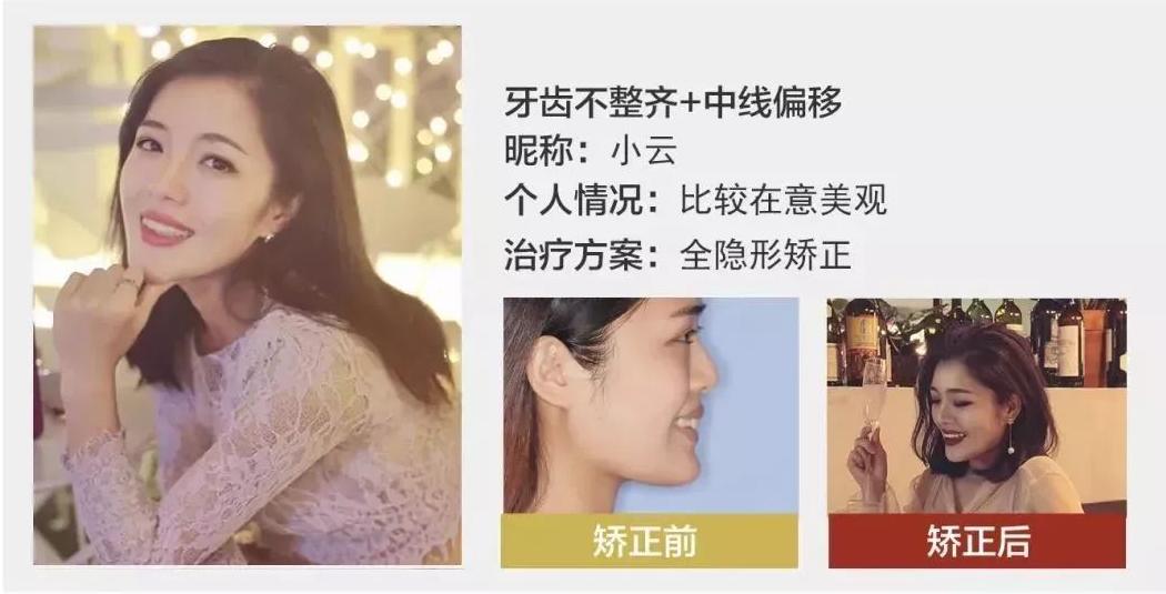 好羡慕别人有一口好牙齿,早日拥有一口整齐更漂亮的牙齿