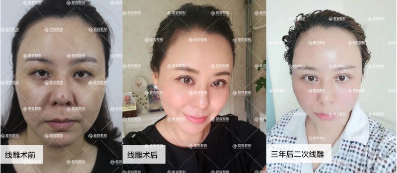 线雕抗衰老的方法,线雕改变了脸型丑死了咋办