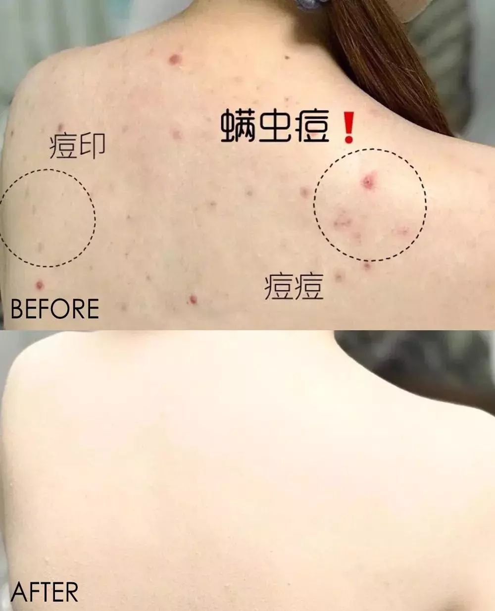 挤痘痘出来的白色长条状是什么,痘痘黑头挤出白颗粒