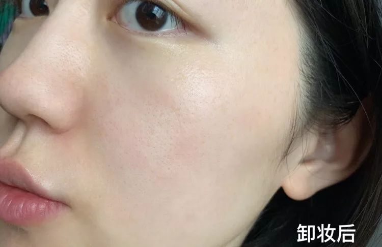 挤痘痘出来的白色长条状是什么,痘痘黑头挤出白颗粒