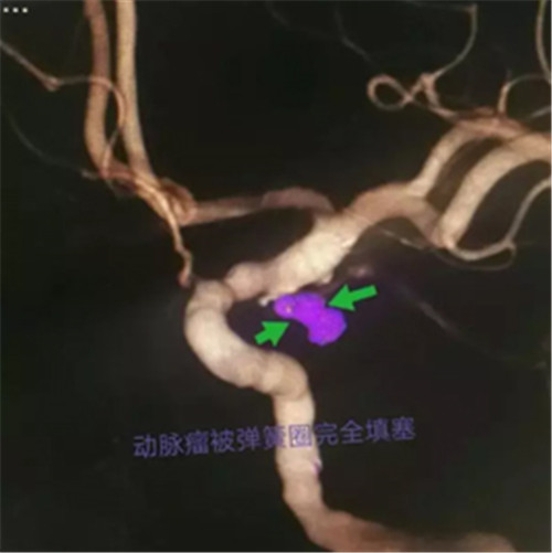 左侧头痛警惕四种病征兆,老年人头痛警惕四种病