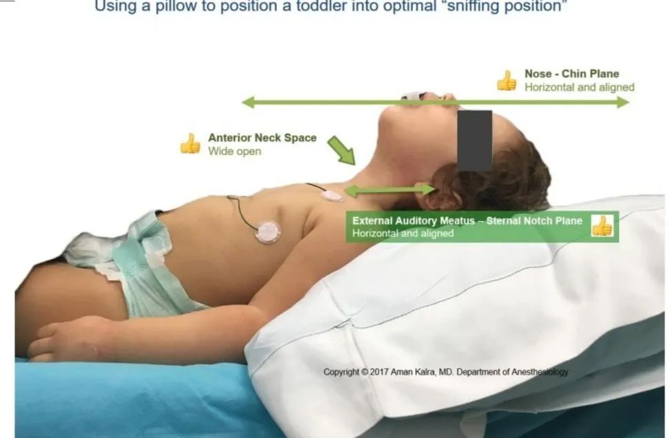 气道异物患者麻醉,小儿气道异物麻醉