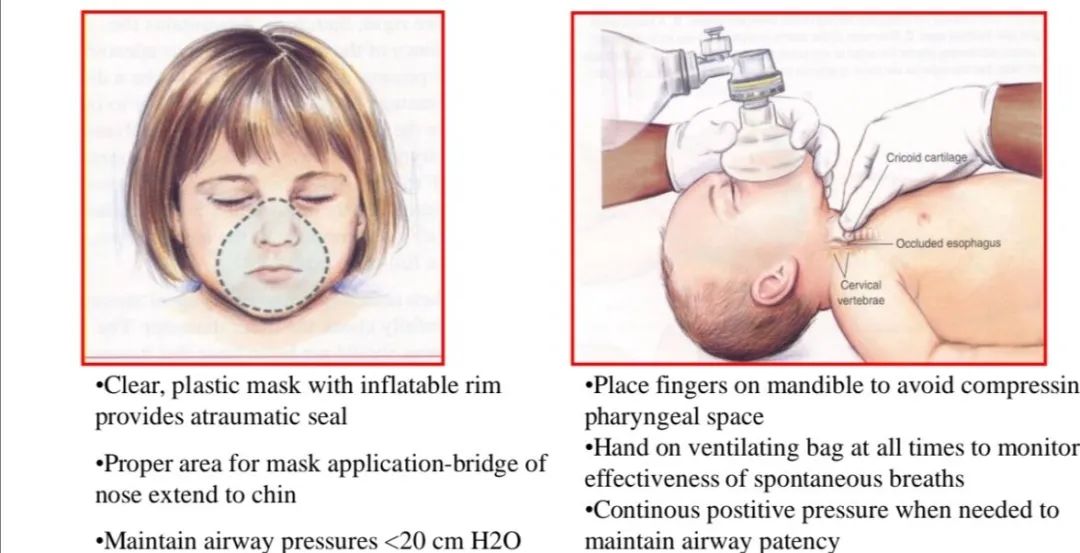 气道异物患者麻醉,小儿气道异物麻醉