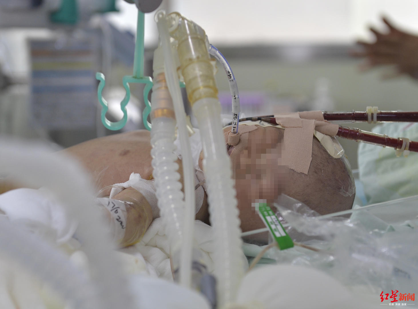 ecmo抢救新生儿,新生儿ecmo抢救无效纪录片