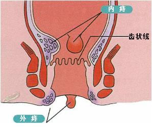 超声多普勒引导下痔疮手术多少钱,超声多普勒治疗痔疮优缺点