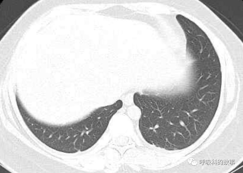 五花八门的发热之一—药物热(1)