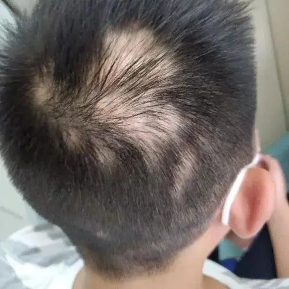 杭州六年级男孩出现斑秃医生：学习压力大