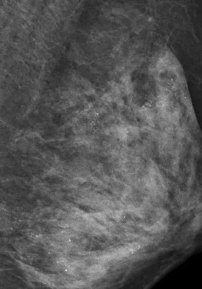 乳房按摩治病还是致病,乳房按摩致癌案例