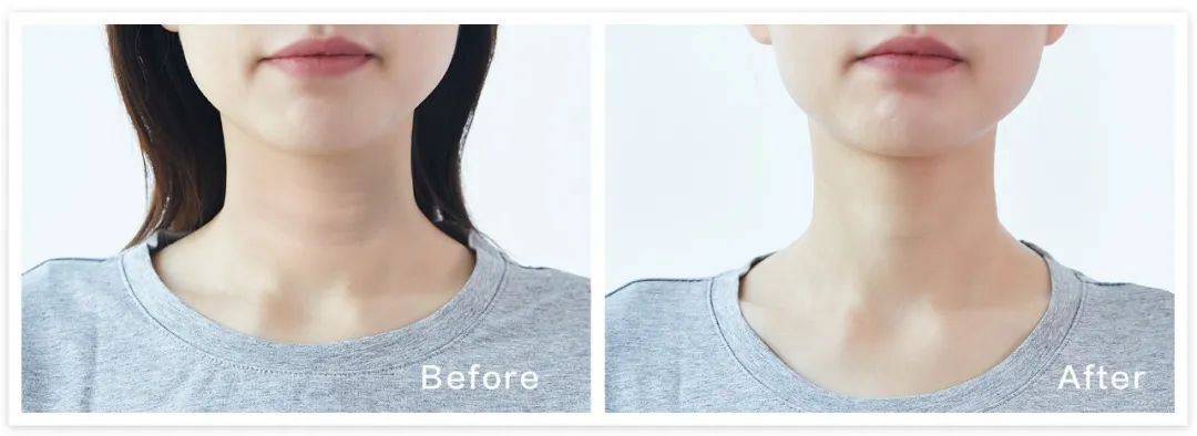 一条颈纹老十岁教你一招淡化,女人脖子有颈纹和年龄有关吗