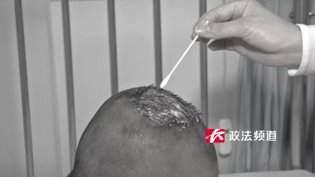 长沙7岁女孩大量脱发,头顶还长出大脓包!原因万万想不到