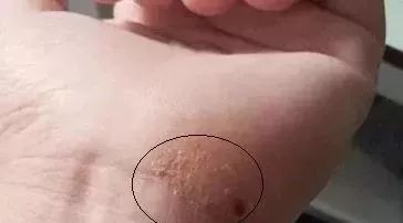 手上长了一颗颗透明的像水泡一样,手上长透明小水泡是什么原因引起