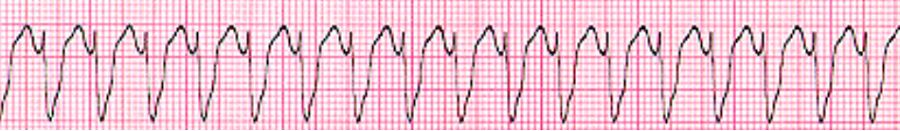 室速属于重大疾病吗,室速的相关资料