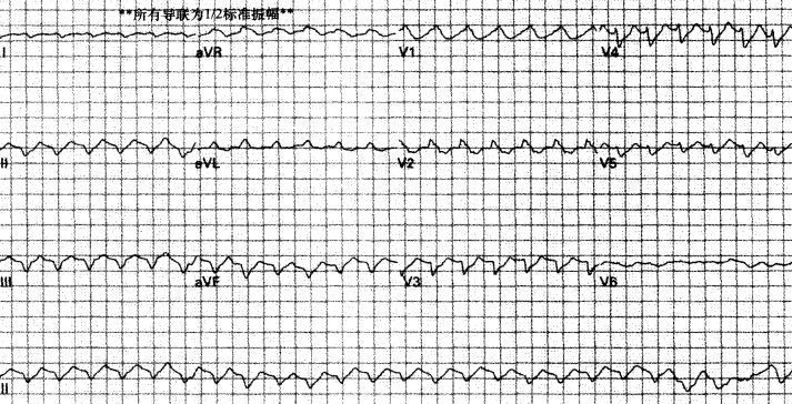 室速属于重大疾病吗,室速的相关资料