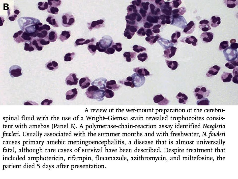 游泳得脑膜炎,游泳发烧会引起脑损伤吗