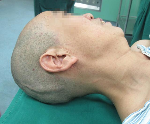 脑积水腹腔分流术后头晕头痛,脑积水分流术后发烧会有什么后果