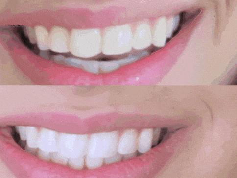 牙齿酸用抗敏感牙膏有效,抗牙本质敏感牙膏