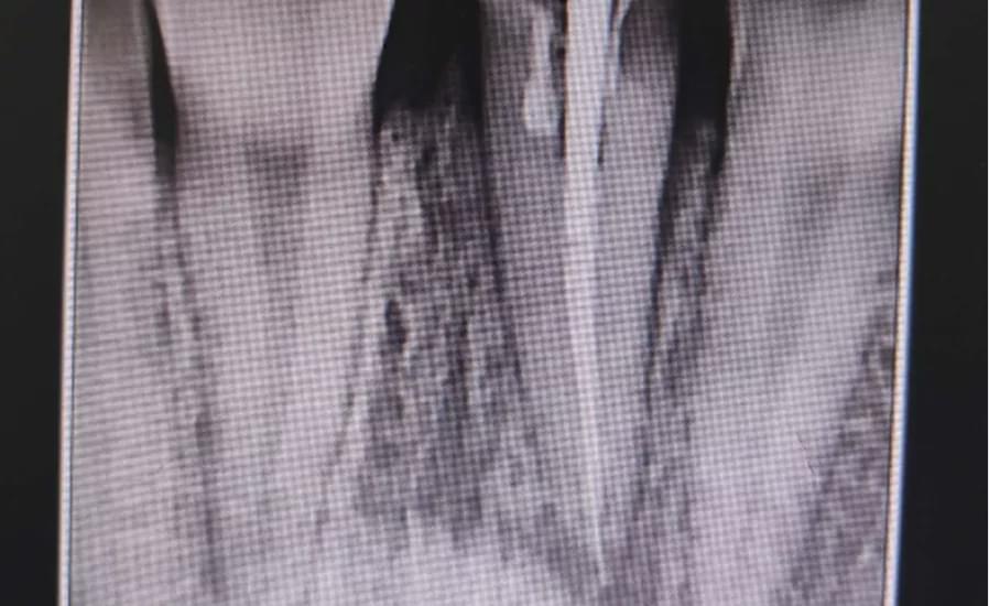 门牙残缺可以牙齿矫正吗,北京口腔医院门牙折断能治吗