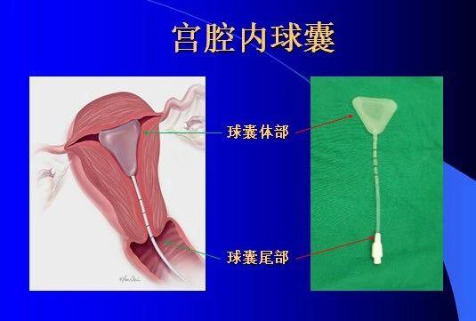 怀孕时宫腔粘连怎么办,宫腔粘连怀孕出血流产