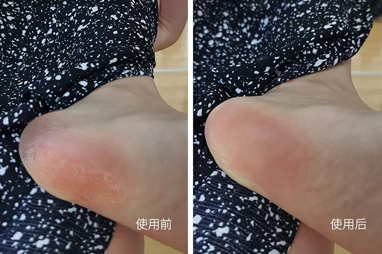 你穿高跟鞋经历过磨脚的痛苦吗,穿高跟鞋脚掌死皮怎么去除