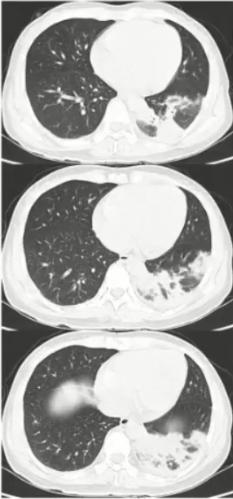 支原体肺炎症状应该注意什么,支原体肺炎这些症状要警惕