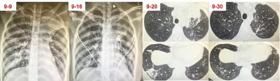 支原体肺炎症状中医诊治,成人肺炎支原体肺炎诊治专家共识