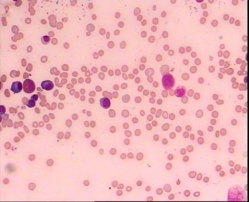 胆囊结石超声检查是常见的假阳性,遗传性球形红细胞增多症胆结石