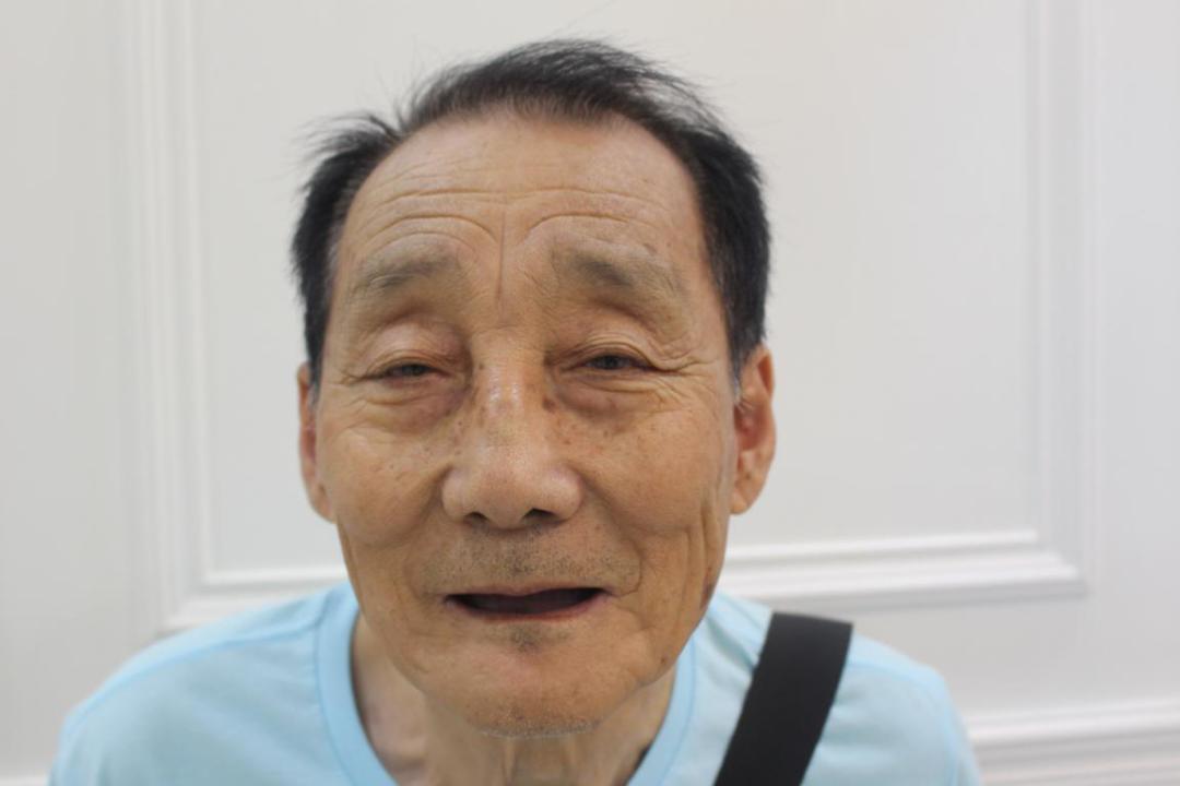 32岁男子几乎牙齿掉光,20岁小伙牙齿掉光