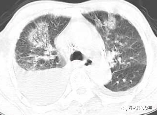 肺炎的最佳治疗方法及药物,肺炎的治疗方法和流程