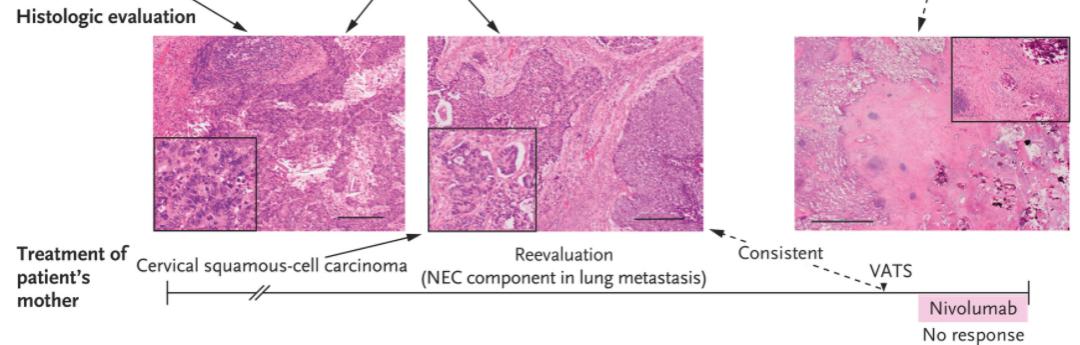 NEJM：宫颈癌细胞竟能经产道进入婴儿的肺！科学家首次发现宫颈癌母亲顺产导致儿子患肺癌的案例，母子肿瘤基因谱高度吻合丨临床大发现