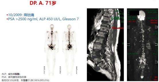 魏强、TOMBAL教授：恩扎卢胺临床数据与实践前沿