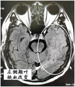 硬脑膜动静脉瘘介入栓塞后的治疗,宣武医院硬脑膜动静脉瘘的治疗