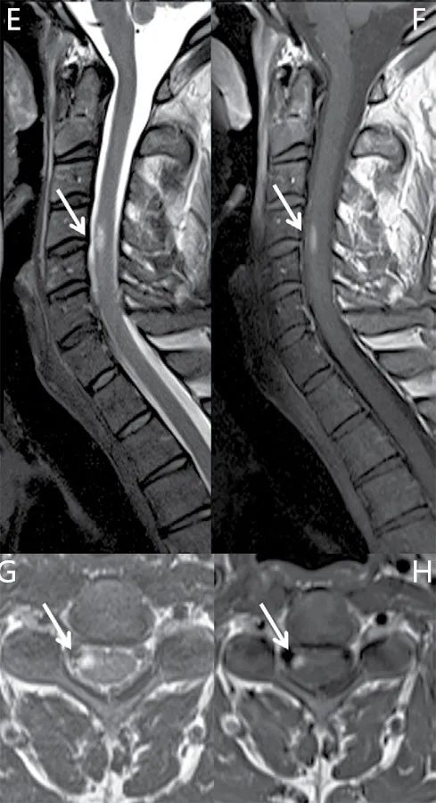 最新多发性硬化诊断标准的解读,多发性硬化患者必练动作