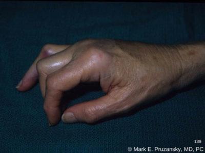 疼！厦门一女子边切菜边闲聊，菜刀剁掉指头肉！医生：或变“纽扣指”