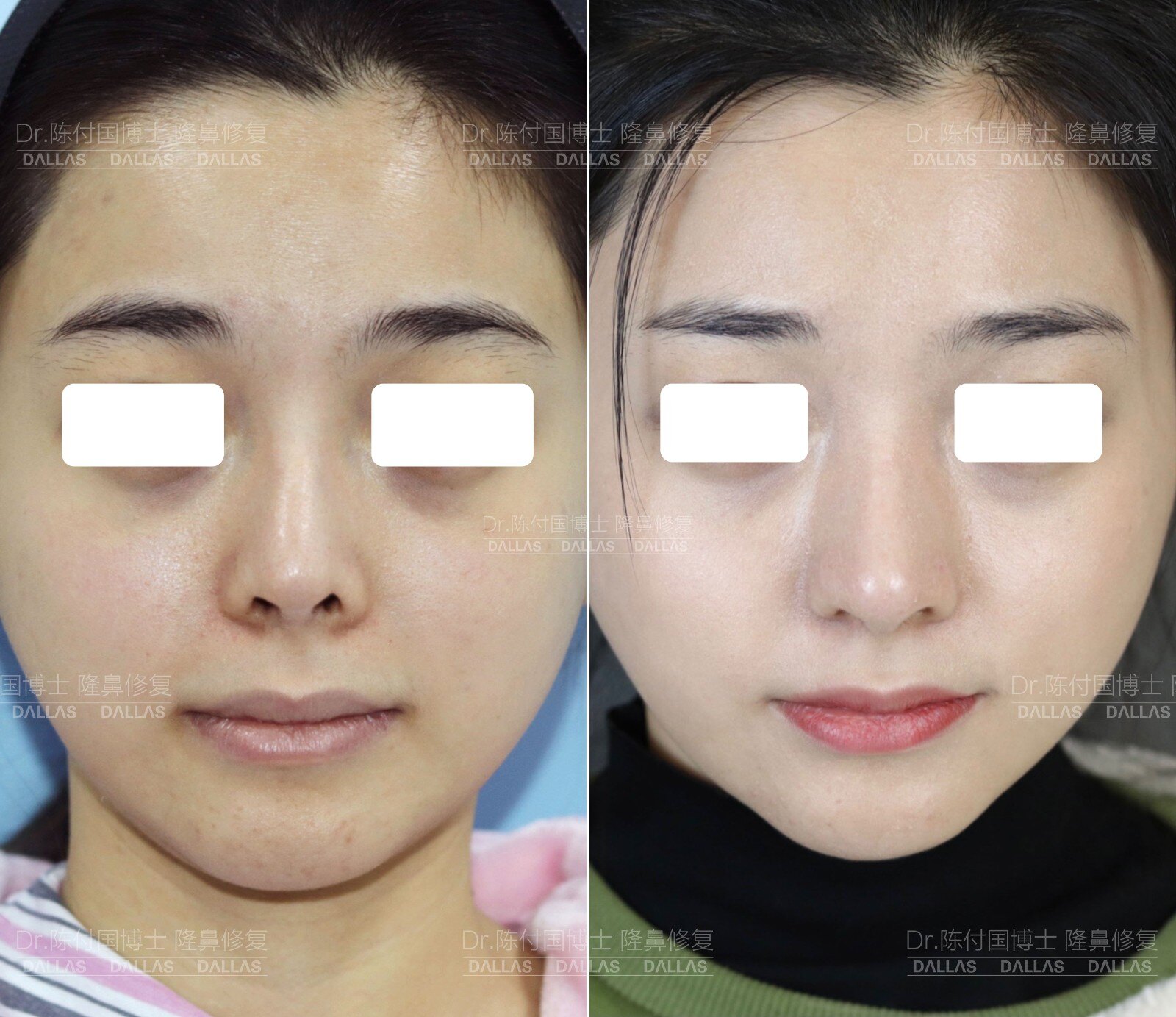 隆鼻鼻尖显形露鼻孔怎么修复,隆鼻修复微驼峰