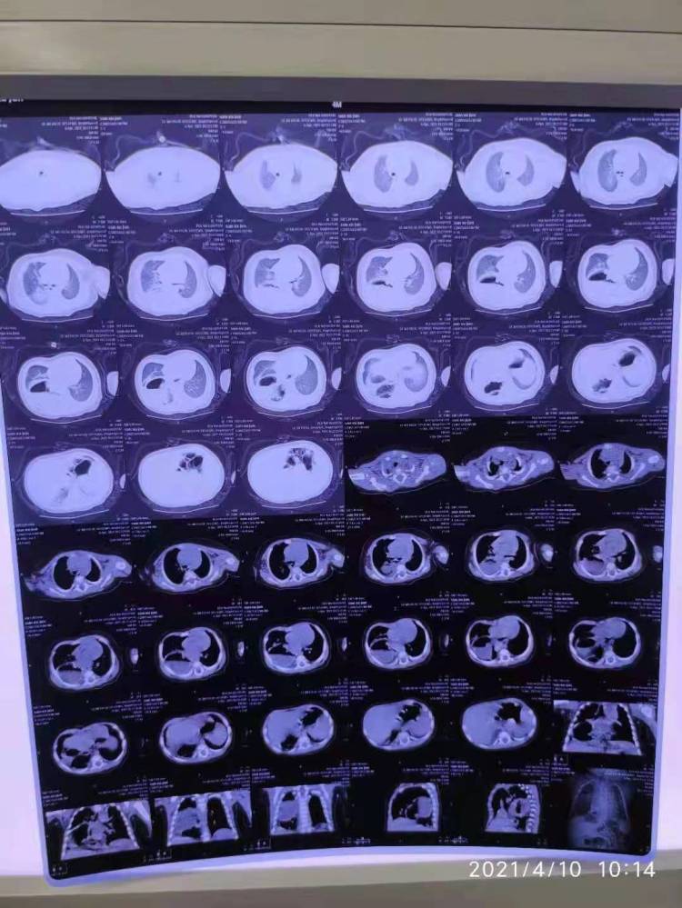 腹腔脏器修补术有哪些,腹腔探查手术戳孔位置