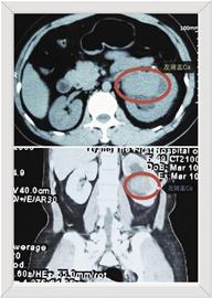 肾盂癌根治术下腹部切口有多大,肾盂癌术后辅助治疗方案