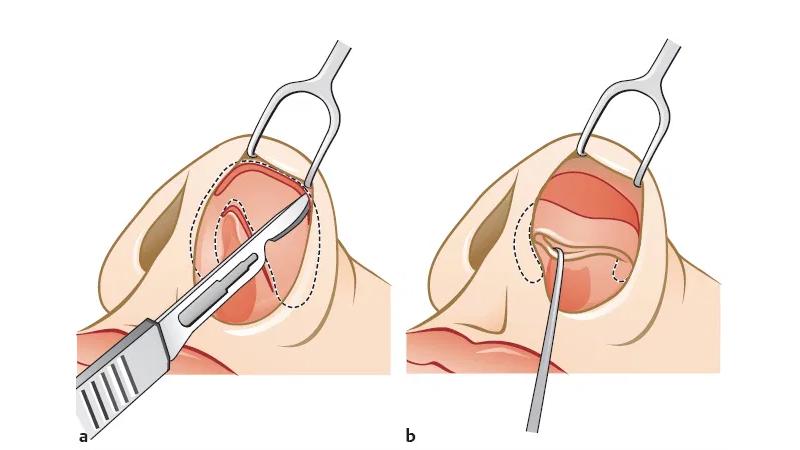 鼻综合整形切口,鼻综合切口处愈合几率