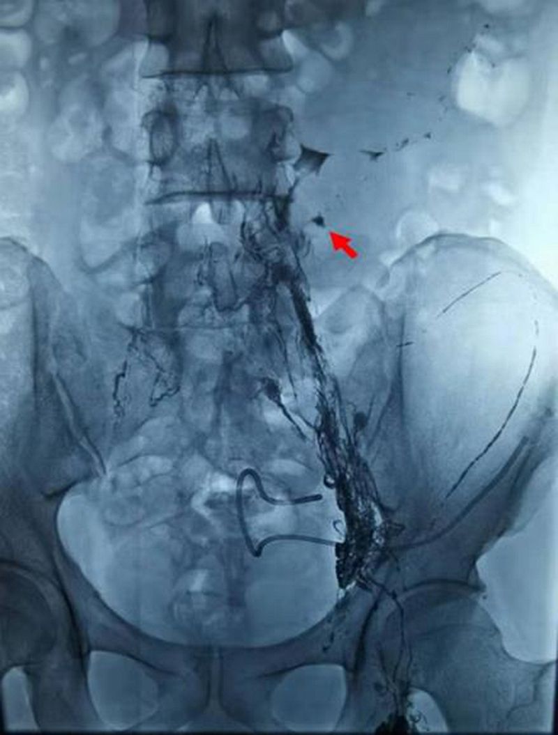 微创免费治疗成功案例,微创淋巴手术