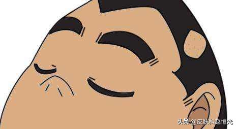 斑秃怎么治疗才能长得快,得了斑秃怎么样治疗好得快