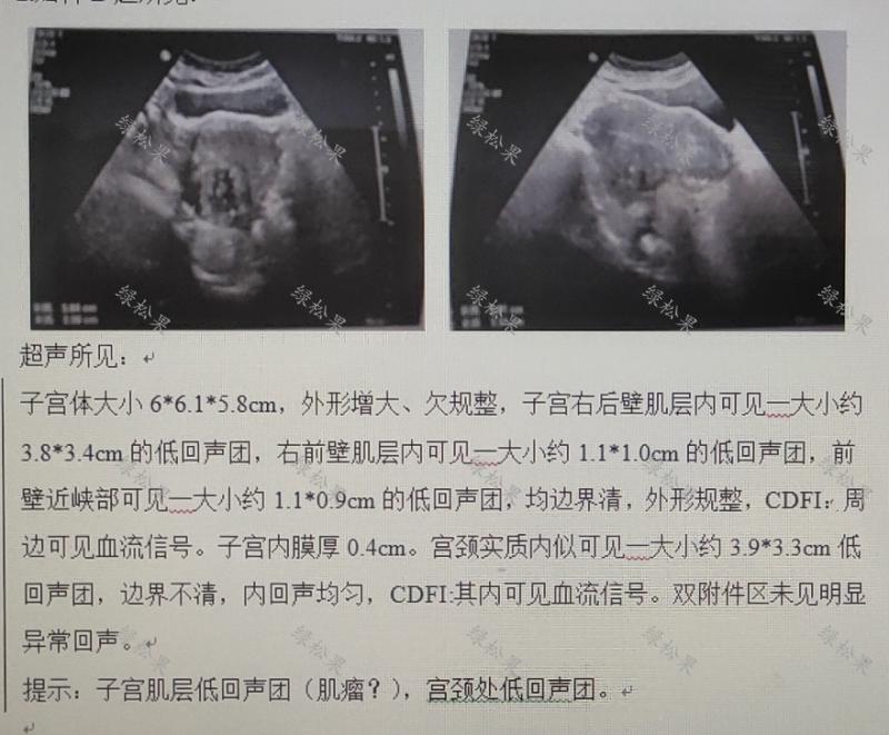 绝经几年了下身出血是宫颈癌吗,绝经后多年又出血一定是宫颈癌吗