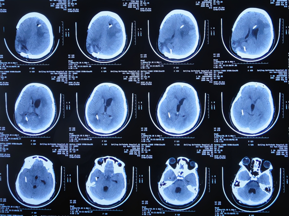 脑室有粘连脑积水有什么办法,脑动脉畸形手术后出现急性脑积水