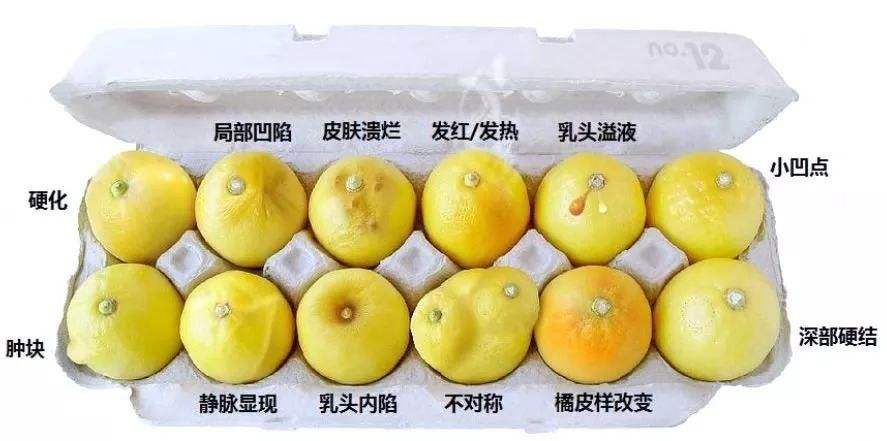 乳房这4个症状，只要出现1个，不论男女，尽快去医院检查