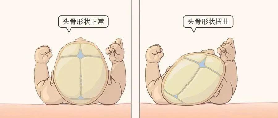 婴儿戴头盔矫正头型变畸形,婴儿戴摩托头盔