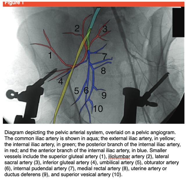 骨盆骨折动脉破裂介入治疗,骨盆骨折髂内动脉栓塞