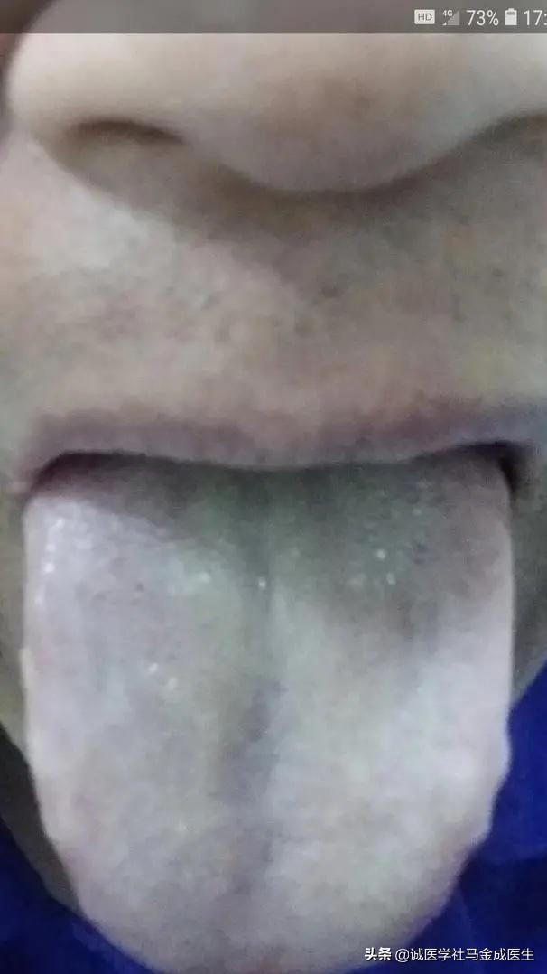 麻疹鉴别视频,荨麻疹寒热怎么治疗