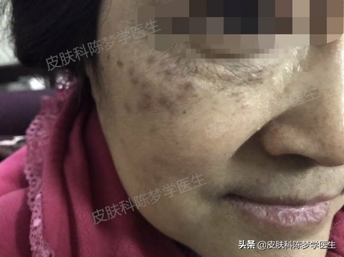 褐青色痣斑吃什么中药好,如何治疗脸上褐青色痣样斑